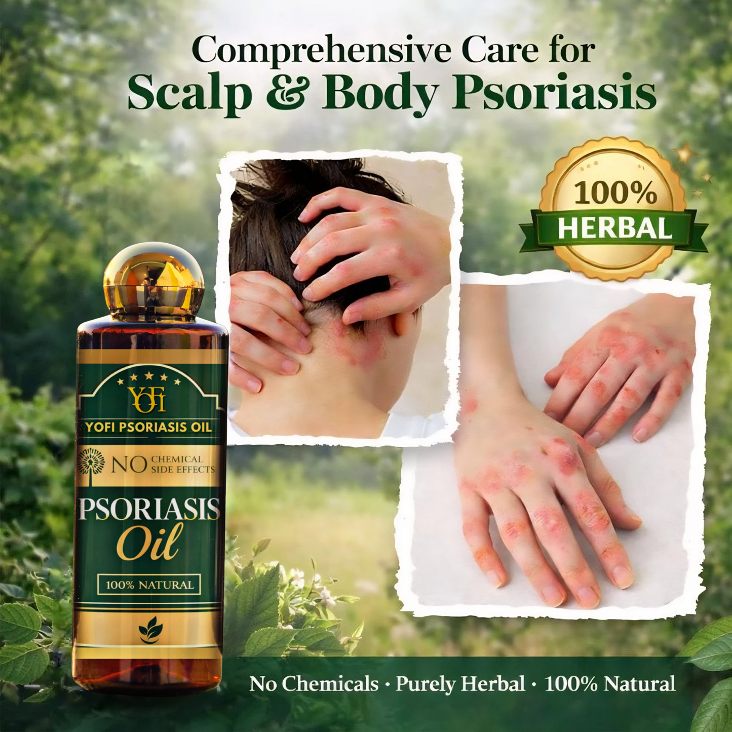 YUFI Herbal Psoriasis -Clearing Oil