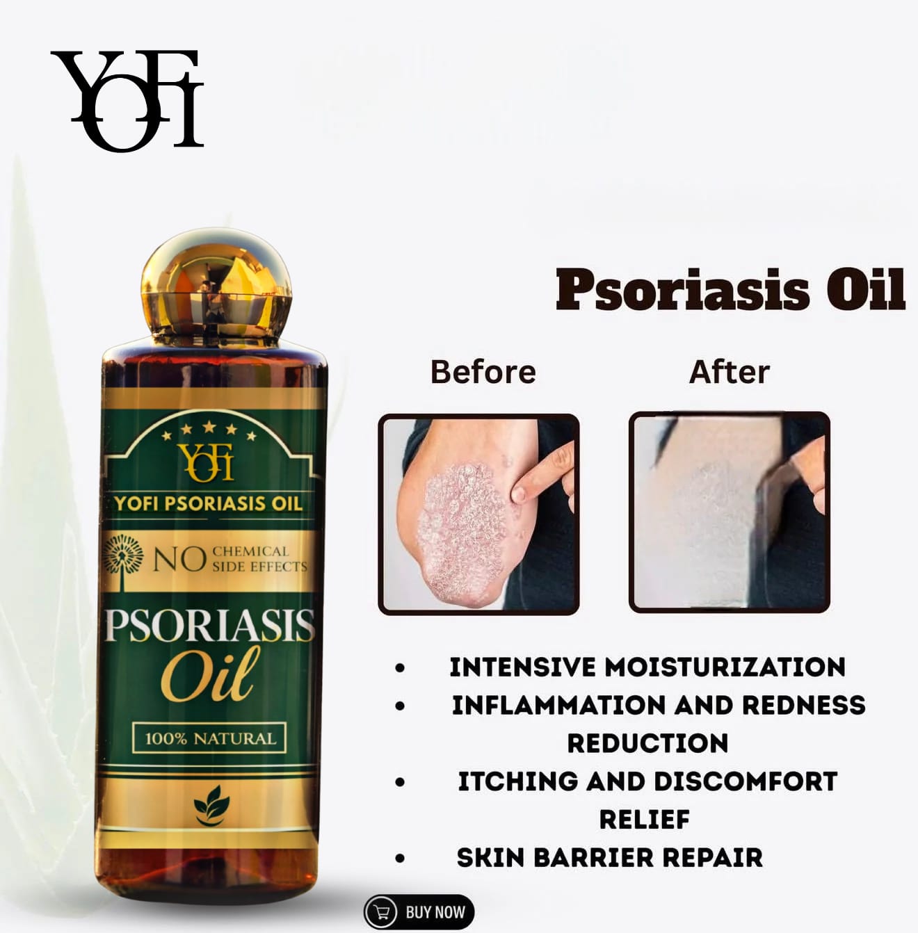 YUFI Herbal Psoriasis -Clearing Oil