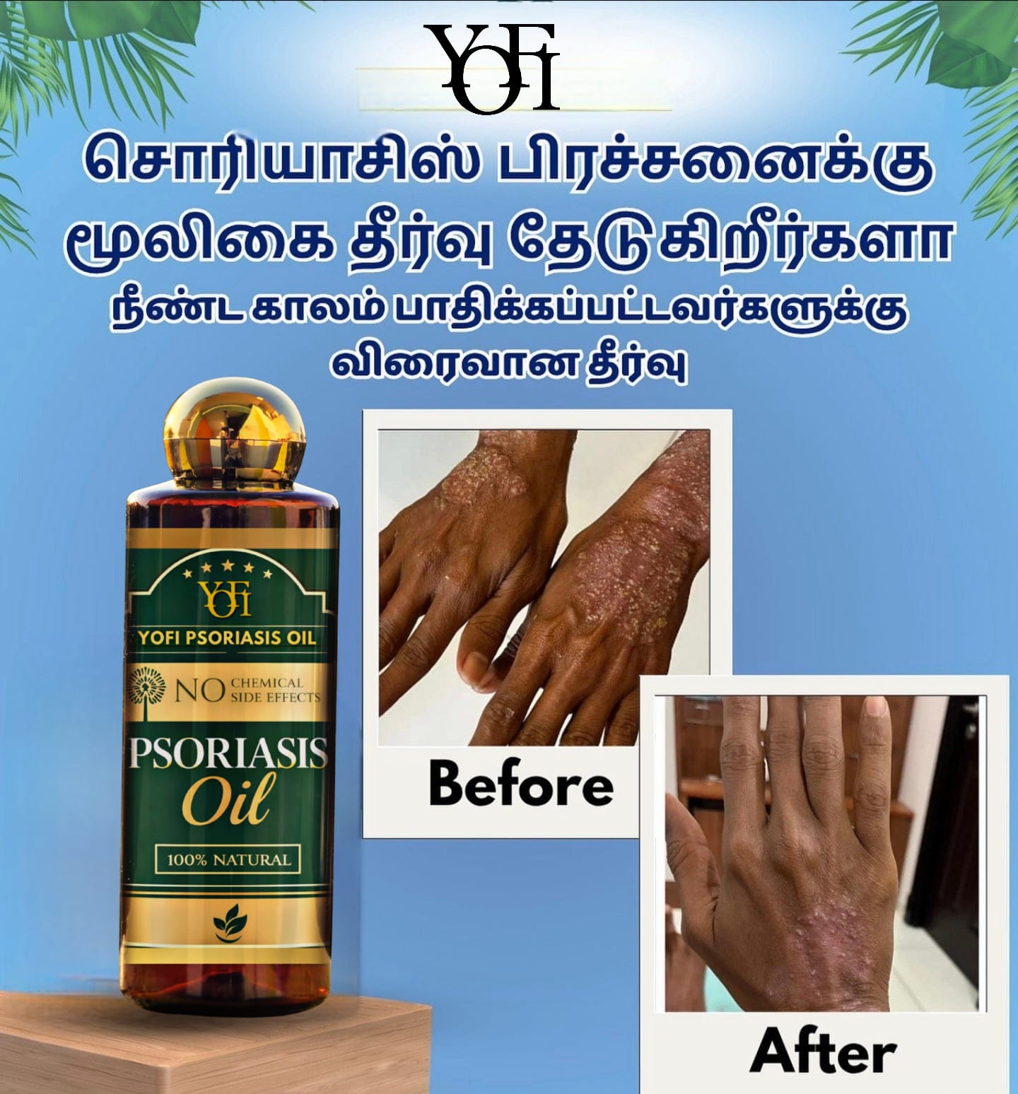 YUFI Herbal Psoriasis -Clearing Oil